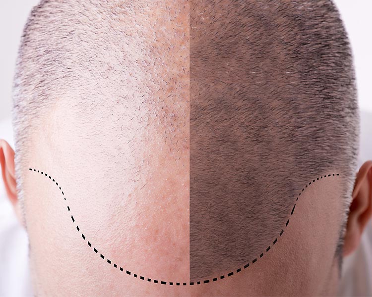 after hair transplant care