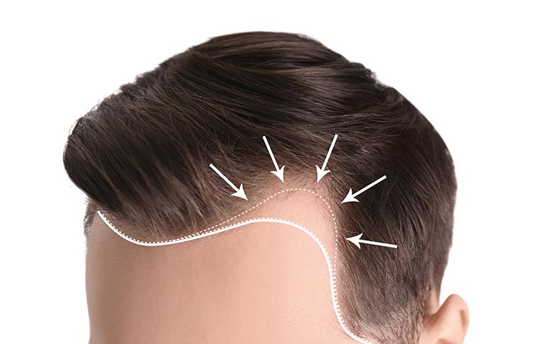 after hair transplant