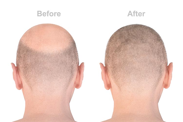 before and after hair transplant