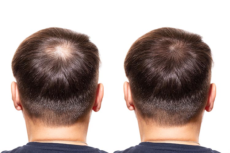 fue hair transplant results